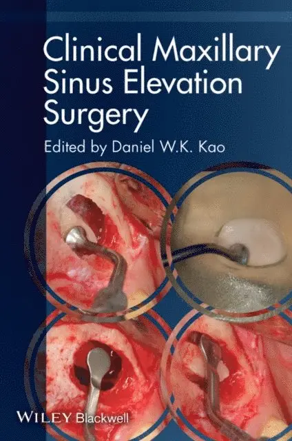 Daniel W. K. Kao - Clinical Maxillary Sinus Elevation Surgery, E-bok. Tillgänglighet: Lägg i varukorg