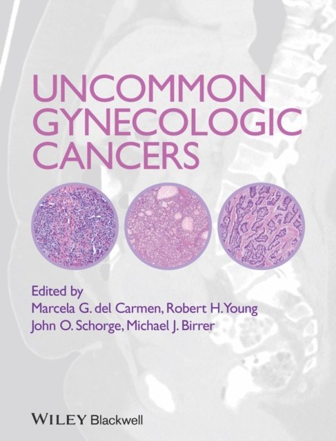 Robert H. Young, John O. Schorge, Marcela del Carmen - Uncommon Gynecologic Cancers, E-bok