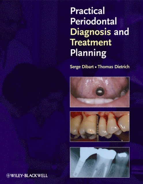 Serge Dibart, Thomas Dietrich - Practical Periodontal Diagnosis and Treatment Planning, E-bok