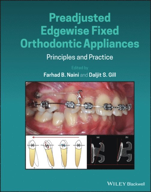 Daljit S. Gill, Farhad B. Naini - Preadjusted Edgewise Fixed Orthodontic Appliances, E-bok