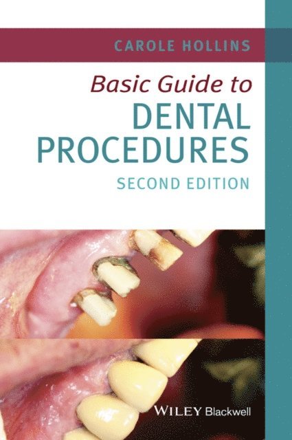 Carole Hollins - Basic Guide to Dental Procedures, E-bok