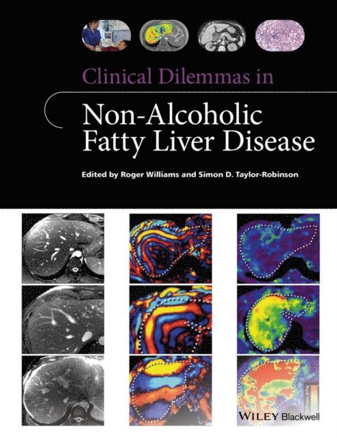 Simon D. Taylor-Robinson, Roger Williams - Clinical Dilemmas in Non-Alcoholic Fatty Liver Disease, E-bok