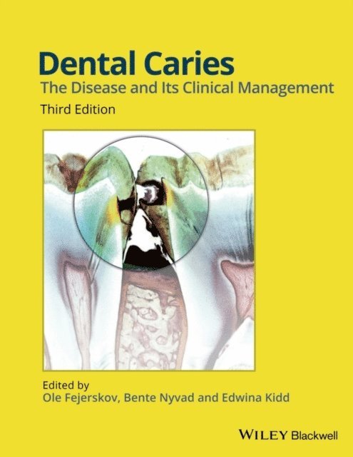 Ole Fejerskov, Bente Nyvad, Edwina Kidd - Dental Caries: The Disease and its Clinical Management, 3rd Edition, Häftad