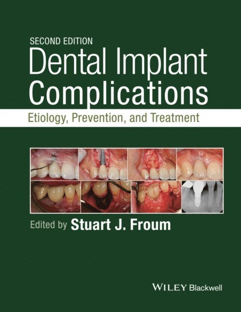 Stuart J. Froum - Dental Implant Complications, E-bok