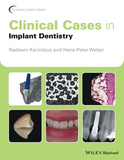 Hans-Peter Weber, Nadeem Karimbux - Clinical Cases in Implant Dentistry, E-bok