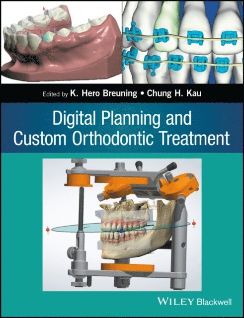 Chung H. Kau, K. Hero Breuning - Digital Planning and Custom Orthodontic Treatment, E-bok