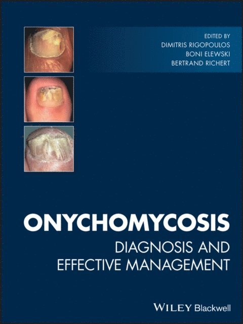 Bertrand Richert, Boni Elewski, Dimitris Rigopoulos - Onychomycosis, E-bok