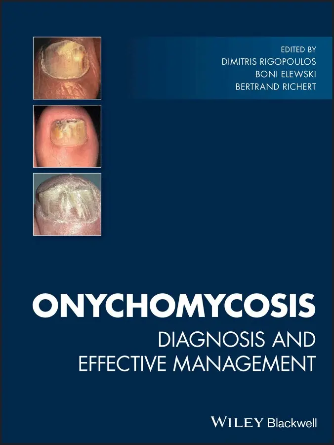 Dimitris Rigopoulos, Boni Elewski, Bertrand Richert - Onychomycosis – Diagnosis and Effective Management. Tillgänglighet: Tillfälligt slut