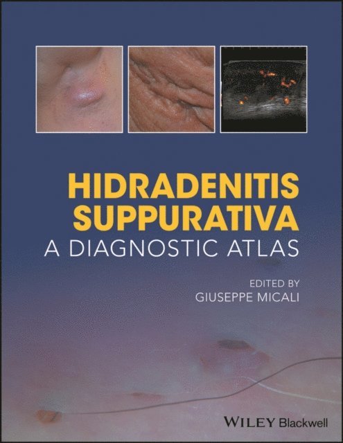 Giuseppe Micali - Hidradenitis Suppurativa, E-bok
