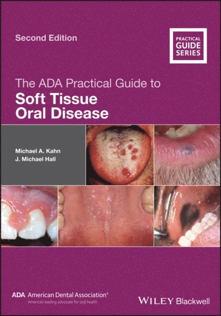 J. Michael Hall, Michael A. Kahn - ADA Practical Guide to Soft Tissue Oral Disease, E-bok