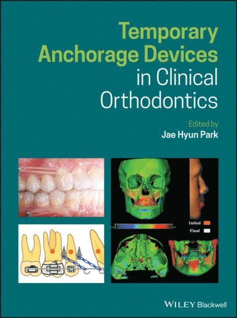 Jae Hyun Park - Temporary Anchorage Devices in Clinical Orthodontics, E-bok