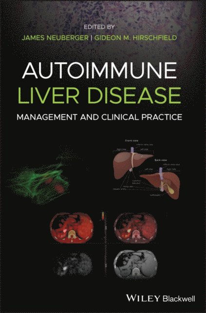 Gideon M. Hirschfield, James Neuberger - Autoimmune Liver Disease, E-bok