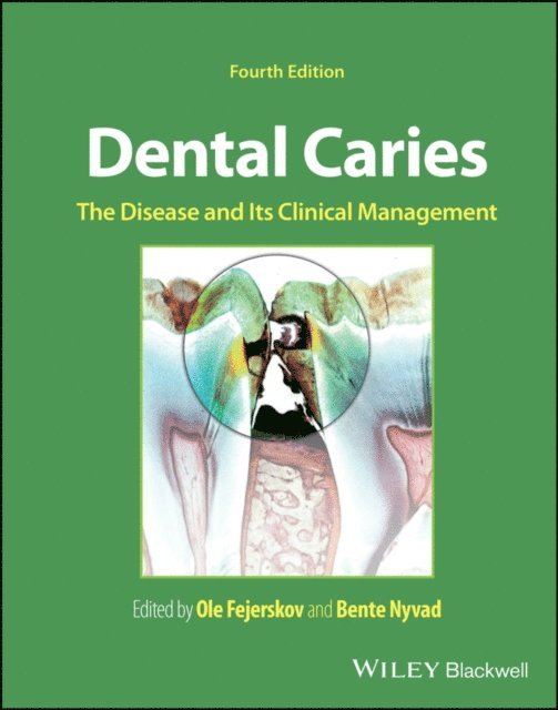Bente Nyvad, Ole Fejerskov - Dental Caries, E-bok