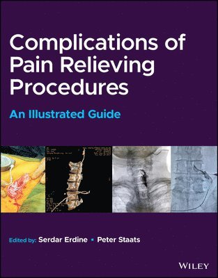 Serdar Erdine, Peter S. Staats - Complications of Pain-Relieving Procedures, Inbunden