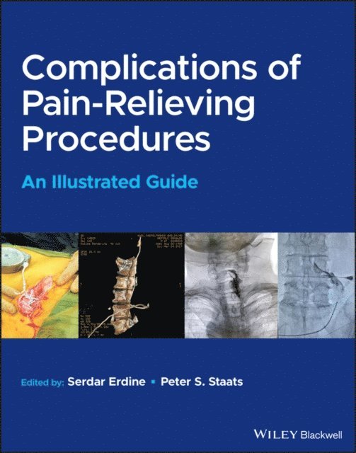 Peter S. Staats, Serdar Erdine - Complications of Pain-Relieving Procedures, E-bok