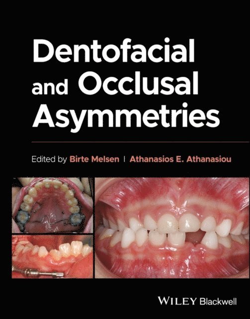 Athanasios E. Athanasiou, Birte Melsen - Dentofacial and Occlusal Asymmetries, E-bok