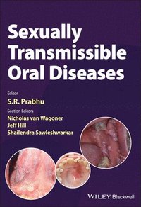 Sexually Transmissible Oral Diseases