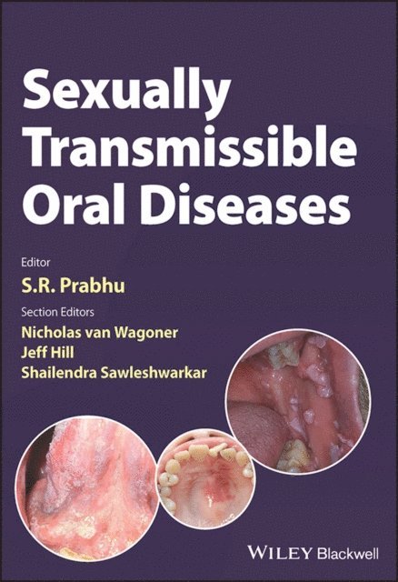 S. R. Prabhu - Sexually Transmissible Oral Diseases, E-bok