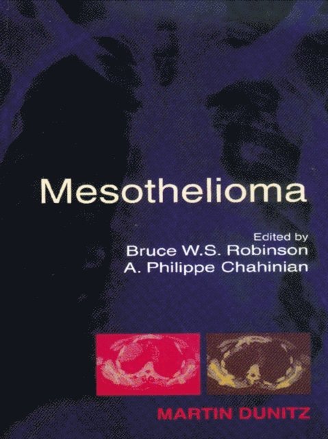 A Philippe Chahinian, Bruce W S Robinson - Mesothelioma, E-bok. Tillgänglighet: Lägg i varukorg