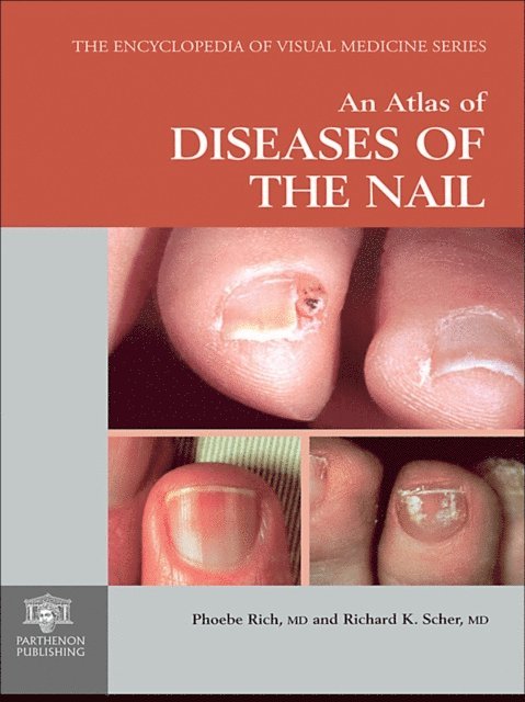 Richard K. Scher, Phoebe Rich - Atlas of Diseases of the Nail, E-bok