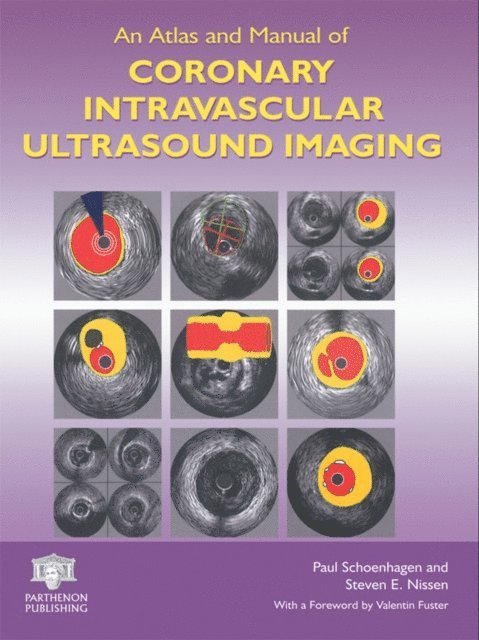 Steven E. Nissen, Paul Schoenhagen - Atlas and Manual of Coronary Intravascular Ultrasound Imaging, E-bok