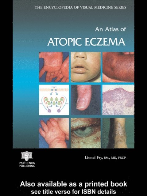 Lionel Fry - Atlas of Atopic Eczema, E-bok