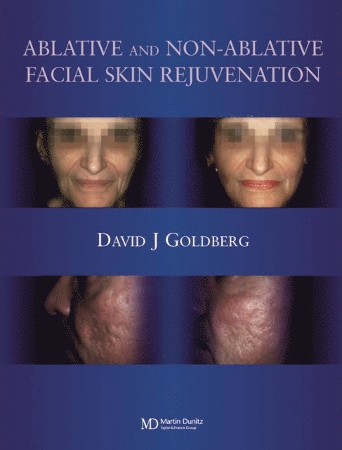 David J. Goldberg - Ablative and Non-ablative Facial Skin Rejuvenation, E-bok