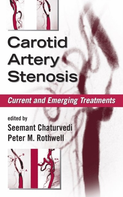 Peter M. Rothwell, Seemant Chaturvedi - Carotid Artery Stenosis, E-bok