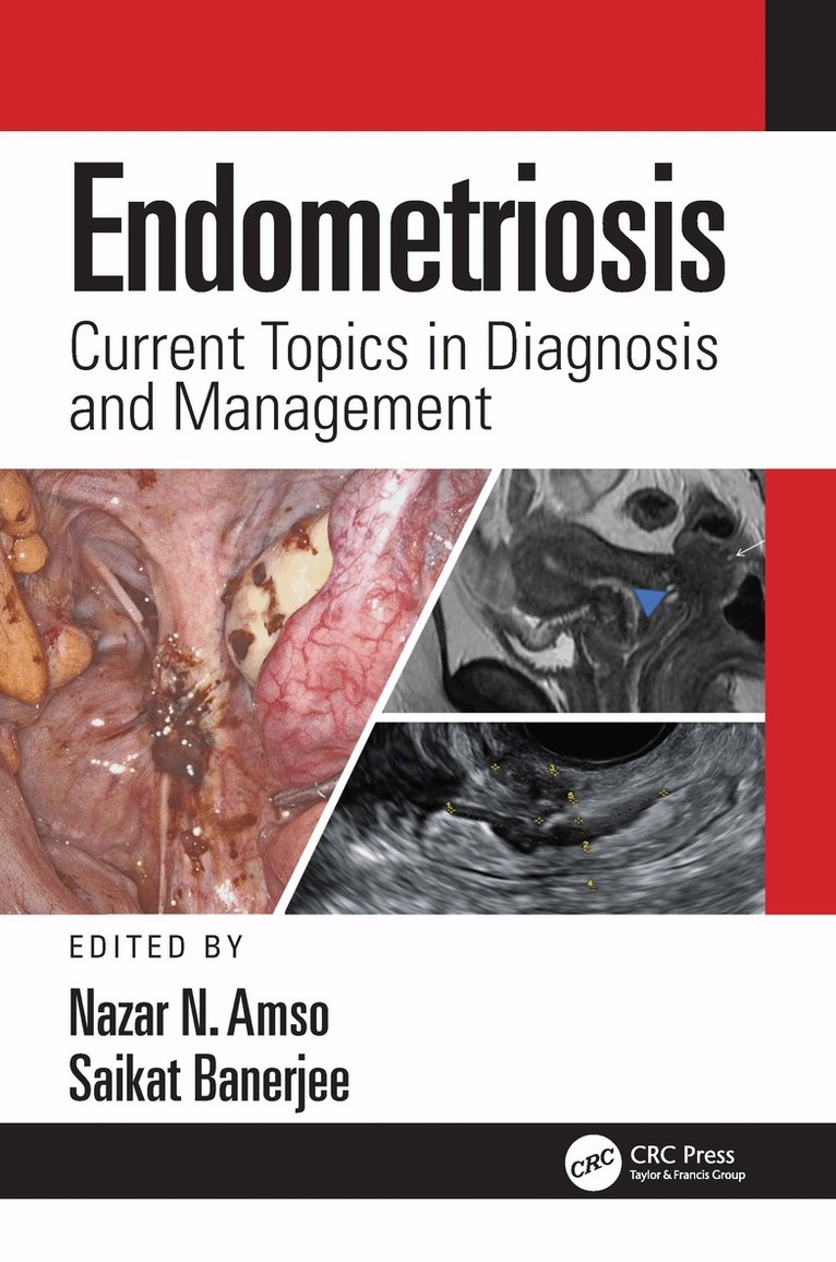 Nazar Amso, Saikat Banerjee - Endometriosis, Inbunden
