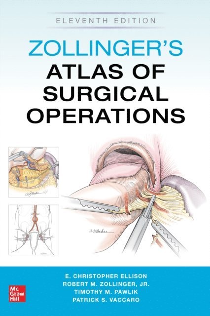 Patrick Vaccaro, Timothy M. Pawlik, E. Christopher Ellison, Robert M. Zollinger - Zollinger's Atlas of Surgical Operations, Eleventh Edition, E-bok