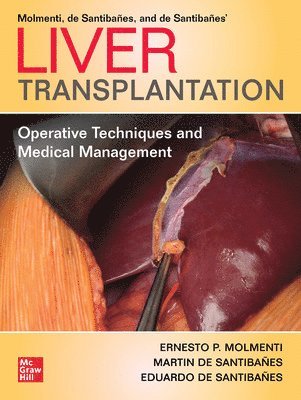 Ernesto P. Molmenti, Martin de Santibañes, Eduardo de Santibañes - Liver Transplantation: Operative Techniques and Medical Management, Häftad