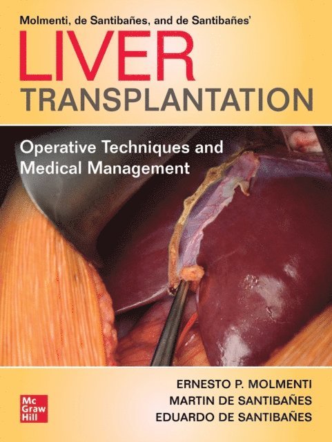 Eduardo de Santibanes, Martin de Santibanes, Ernesto P. Molmenti - Liver Transplantation: Operative Techniques and Medical Management, E-bok