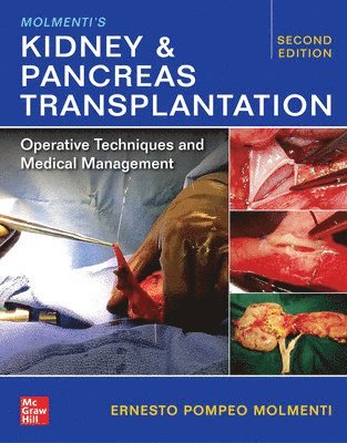 Ernesto P. Molmenti - Molmenti's Kidney and Pancreas Transplantation: Operative Techniques and Medical Management, Inbunden