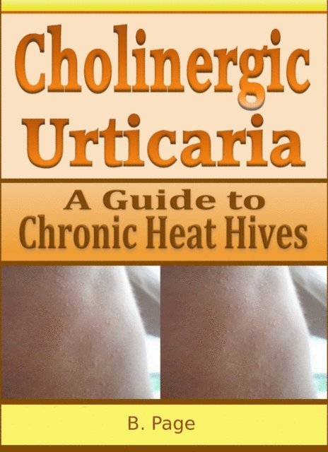 B Page - Cholinergic Urticaria: A Guide to Chronic Heat Hives, E-bok