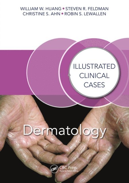 Robin S. Lewallen, Christine S. Ahn, Steven R. Feldman, William W. Huang - Dermatology, E-bok