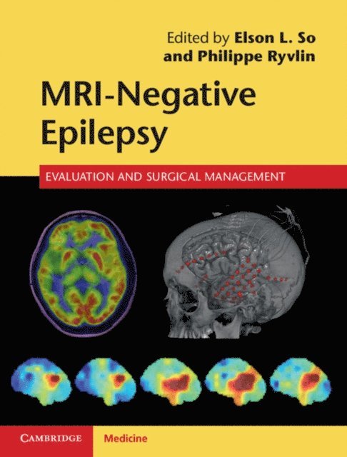 Philippe Ryvlin, Elson L. So - MRI-Negative Epilepsy, E-bok