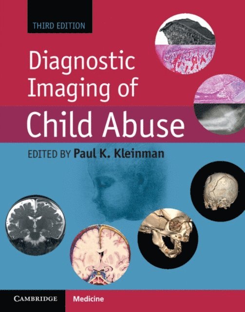 Paul K. Kleinman - Diagnostic Imaging of Child Abuse, E-bok