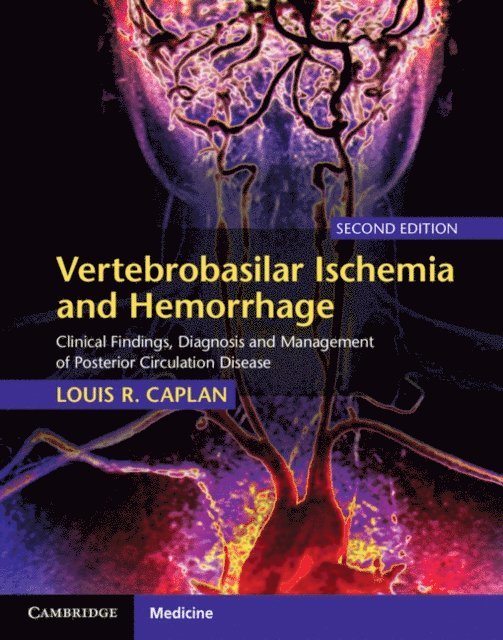 Louis R. Caplan - Vertebrobasilar Ischemia and Hemorrhage, E-bok