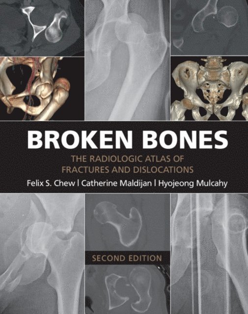 Hyojeong Mulcahy, Catherine Maldijan, Felix S. Chew - Broken Bones, E-bok