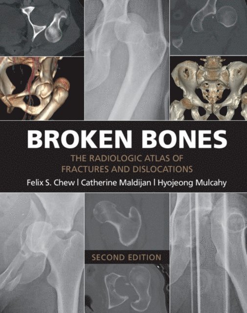 Hyojeong Mulcahy, Catherine Maldijan, Felix S. Chew - Broken Bones, E-bok