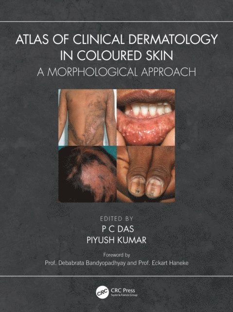 Piyush Kumar, P C Das - Atlas of Clinical Dermatology in Coloured Skin, E-bok