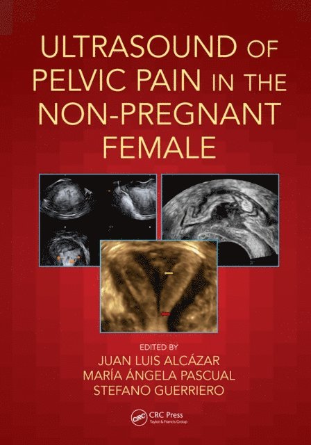 Stefano Guerriero, Maria Angela Pascual, Juan Luis Alcazar - Ultrasound of Pelvic Pain in the Non-Pregnant Patient, E-bok