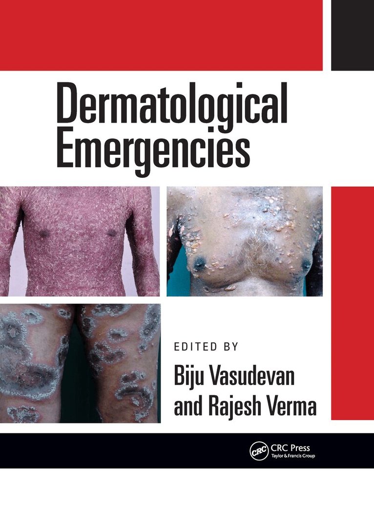 Rajesh Verma, Biju Vasudevan - Dermatological Emergencies, E-bok