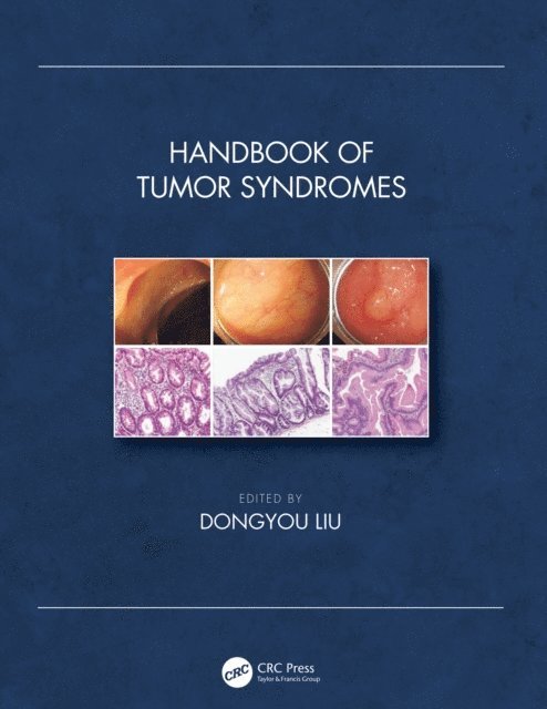Dongyou Liu - Handbook of Tumor Syndromes, E-bok