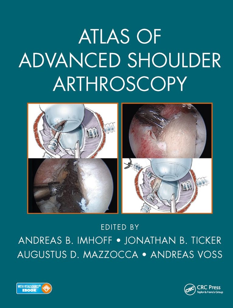 Andreas B. Imhoff, Jonathan B. Ticker, Augustus D. Mazzocca, Andreas Voss - Atlas of Advanced Shoulder Arthroscopy, E-bok