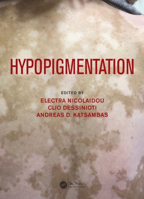 Andreas Katsambas, Clio Dessinioti, Electra Nicolaidou - Hypopigmentation, E-bok