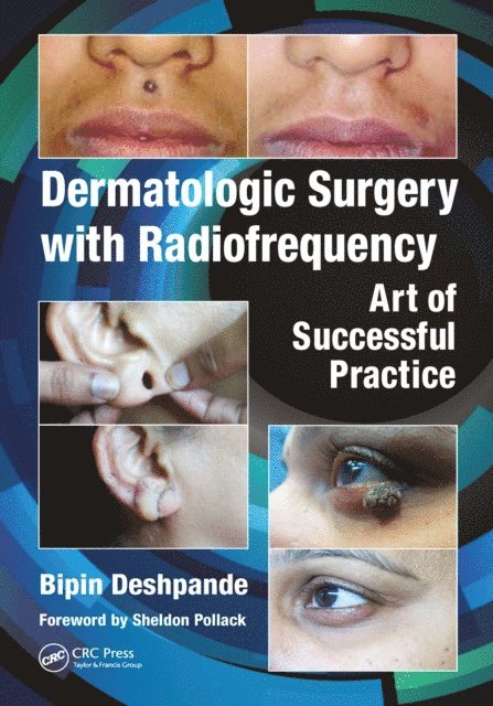 Dermatologic Surgery with Radiofrequency