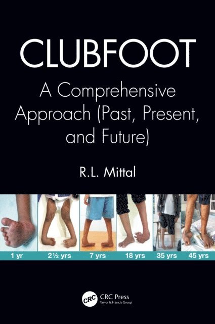R. L. Mittal - Clubfoot, E-bok. Tillgänglighet: Lägg i varukorg
