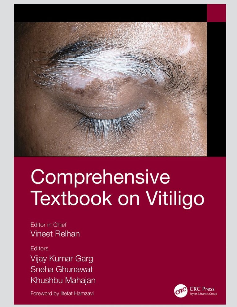 Vineet Relhan, Vijay Kumar Garg, Sneha Ghunawat, Khushbu Mahajan - Comprehensive Textbook on Vitiligo, E-bok