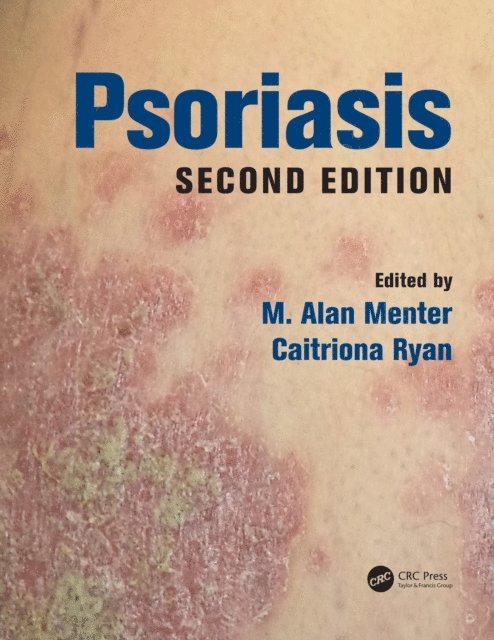 Caitriona Ryan, M. Alan Menter - Psoriasis, E-bok. Tillgänglighet: Lägg i varukorg